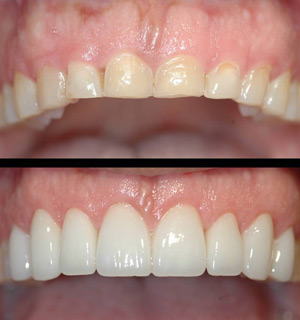 Esthetic Crown Lengthening