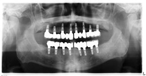 dental implant x-ray