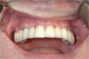 dental implant smile