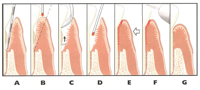 periodontal laser therapy process